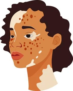 Vitiligo people isolated. Flat vector stock illustration. Stock Illustration