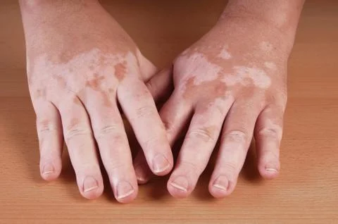 Vitiligo Stock Photos