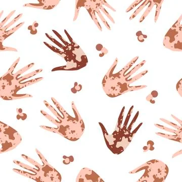 Vitiligo seamless pattern of Hands High five. Pattern with hands with different Stock Illustration