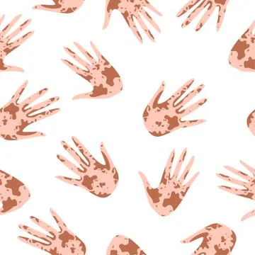 Vitiligo seamless pattern of Hands High five. Pattern with hands with different イラスト素材