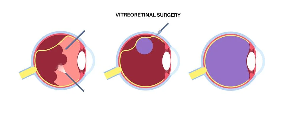 Vitreoretinal surgery poster Stock Illustration