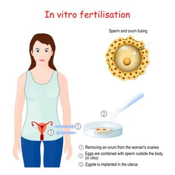 In vitro fertilization (IVF) Stock Illustration