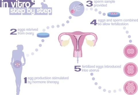 In vitro fertilization step by step Stock Illustration