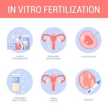 In vitro fertilization step-by-step method. Idea of infertility Illustrazione stock