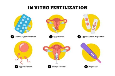 In Vitro Fertilization steps guide infographic poster design, medical illus.. Stock Illustration