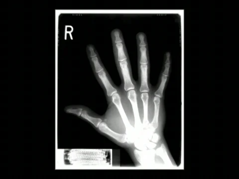 VJ_loop_xRayHand_ZoomIn mr Stock Footage 456895