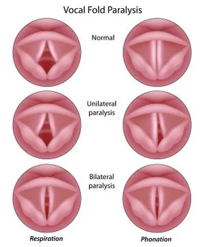 Vocal cord paralysis Stock Illustration