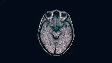Voluminous color MRI brain, head scans and tumor detection. Diagnostic medical Stock Footage