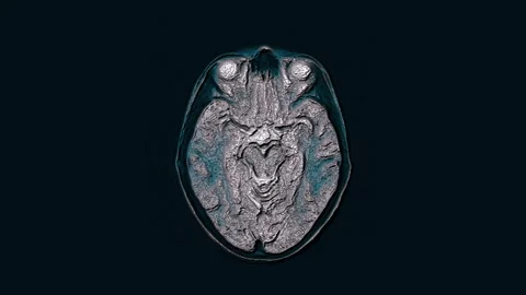 Voluminous color MRI brain, head scans and tumor detection. Diagnostic medical Stock Footage 137225231