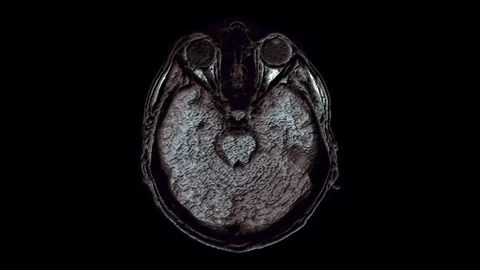 Voluminous color MRI scans of the brain and head to detect tumors. Diagnostic Stock Footage 123713789