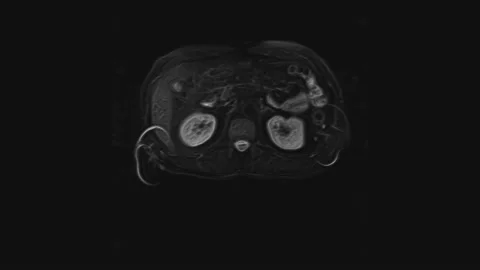 Voluminous CT scan of the abdomen. Computed tomography of the gastrointestinal Stock-Footage 168617987