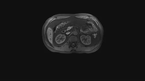 Voluminous CT scan of the abdomen. Computed tomography of the gastrointestinal Video stock 169035812