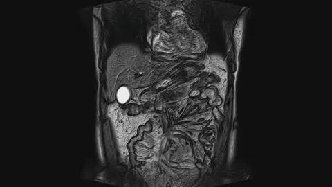 Voluminous CT scan of the abdomen. Computed tomography of the gastrointestinal Video stock 169035907
