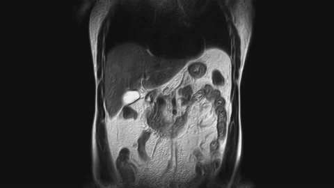 Voluminous CT scan of the abdomen. Computed tomography of the gastrointestinal Stock Footage 169755000