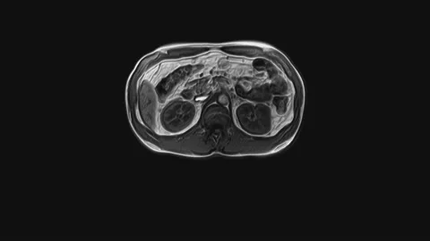 Voluminous CT scan of the abdomen. Computed tomography of the gastrointestinal Stock Footage 169755042