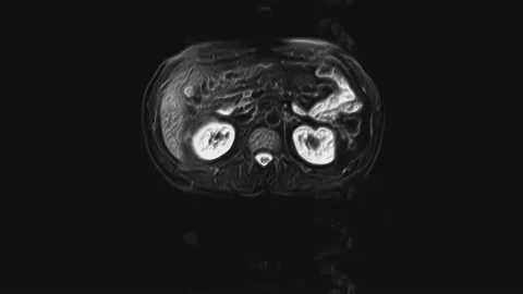 Voluminous CT scan of the abdomen. Computed tomography of the gastrointestinal Stock Footage 170775467