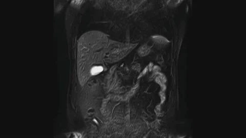 Voluminous CT scan of the abdomen. Computed tomography of the gastrointestinal Video stock 172406208