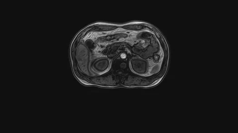 Voluminous CT scan of the abdomen. Computed tomography of the gastrointestinal Stock Footage 172406264