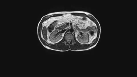 Voluminous CT scan of the abdomen. Computed tomography of the gastrointestinal Stock Footage 199023903