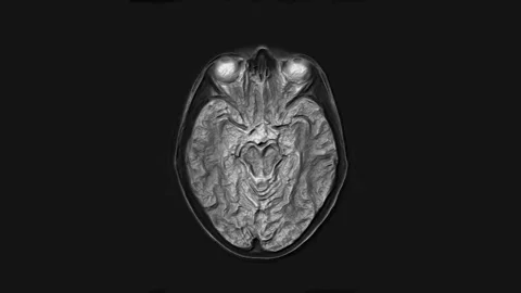 Voluminous MRI brain, head scans and tumor detection. Diagnostic medical tool Stock Footage 136412572