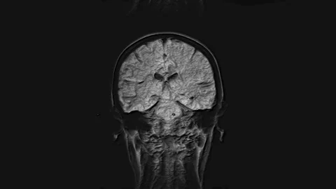 Voluminous MRI brain, head scans and tumor detection. Diagnostic medical tool Stock Footage 137225005