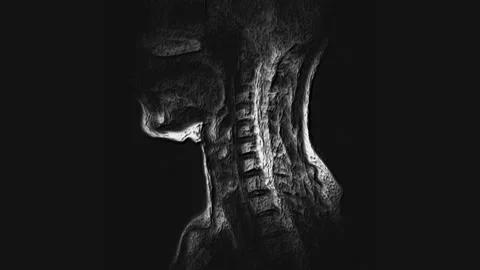 Voluminous MRI of the cervical spine, detection of protrusions and hernias Stock Footage 131027160