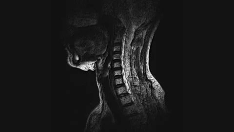 Voluminous MRI of the cervical spine, detection of protrusions and hernias Stock Footage 132799399