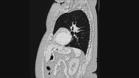 Voluminous MRI of the lungs and bronchi, diagnosis of viral or covid-19 Stock Footage 130796277