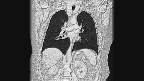 Voluminous MRI of the lungs and bronchi, diagnosis of viral or covid-19 Stock Footage 131566997