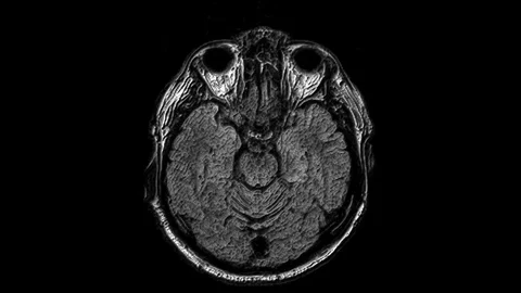 Voluminous MRI scans of the brain and head to detect tumors. Diagnostic medical Stock-Footage 121518567