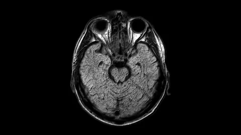 Voluminous MRI scans of the brain and head to detect tumors. Diagnostic medical Stock Footage 122749619