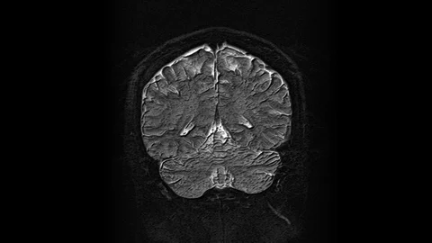 Voluminous MRI scans of the brain and head to detect tumors. Diagnostic medical Stock Footage 123245022