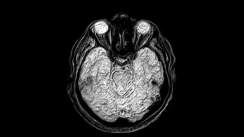 Voluminous MRI scans of the brain and head to detect tumors. Diagnostic medical Stock Footage 123275673
