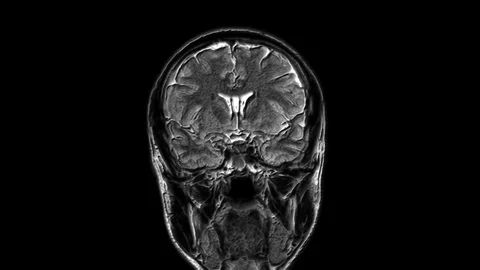 Voluminous MRI scans of the brain and head to detect tumors. Diagnostic medical Stock Footage 123353153