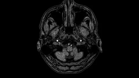 Voluminous MRI scans of the brain and head to detect tumors. Diagnostic medical Stock Footage 123353252