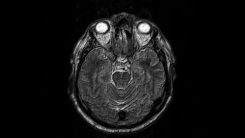 Voluminous MRI scans of the brain and head to detect tumors. Diagnostic medical Stock Footage 123426937
