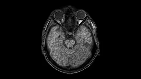 Voluminous MRI scans of the brain and head to detect tumors. Diagnostic medical Stock Footage 124078097