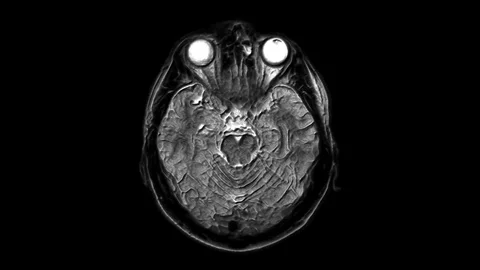 Voluminous MRI scans of the brain and head to detect tumors. Diagnostic medical Stock Footage 124265761