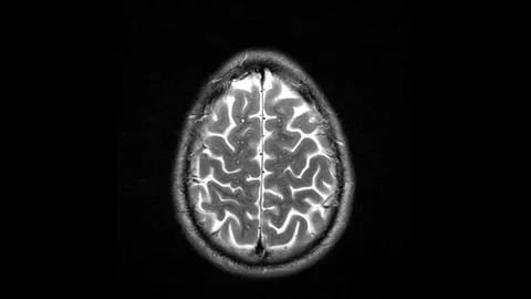 Voluminous MRI scans of the brain and head to detect tumors. Diagnostic medical Stock Footage 316684471