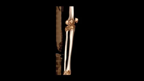 VR imaging of the left knee leg highlighting thin plain bone structures. Stock Footage 319124207