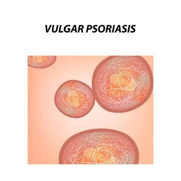 Vulgar psoriasis. Not pustular type of psoriasis. Eczema, skin disease Stock Illustration