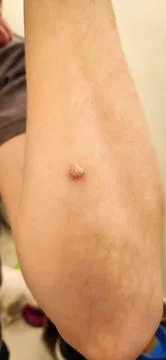 Wart on arm Stock Photos