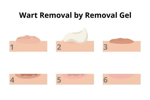 Wart removal process using a removal gel Illustrazione stock