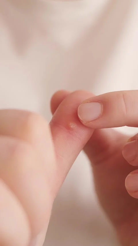 A wart on a woman's finger is a small issue that can be treated with medical met Stock Footage 302797553