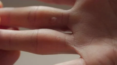 Warts On Fingers Stock Footage 141659148