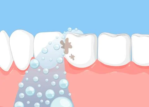 Water Flosser Cleaning Plaque Between Teeth Illustration Stock Illustration