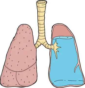 Water in lungs 스톡 일러스트