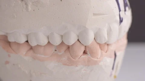 Wax rollers on the tooth model for determining jaw closure Vidéo 101026044