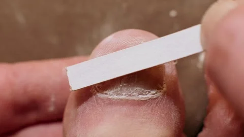 Well-lit close-up of big toe nail with fungal infection undergoing Video stock 268221282
