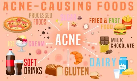 What causes acne. Acne-causing food. Horizontal poster 스톡 일러스트